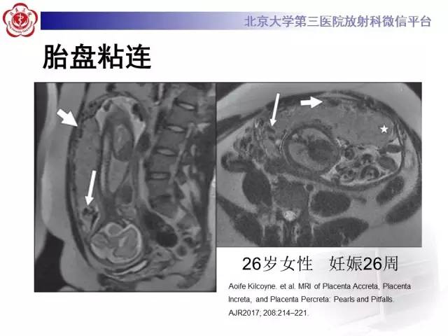 【病例】胎盘植入1例MR影像表现