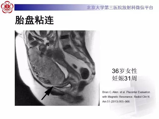 【病例】胎盘植入1例MR影像表现