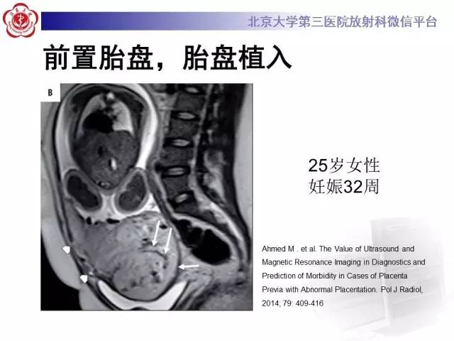 【病例】胎盘植入1例MR影像表现