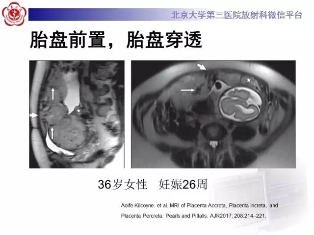 【病例】胎盘植入1例MR影像表现