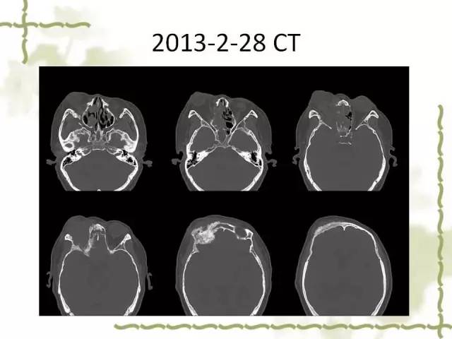 【病例】泪腺多形性腺癌1例MR影像表现