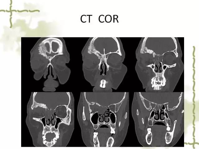 【病例】泪腺多形性腺癌1例MR影像表现