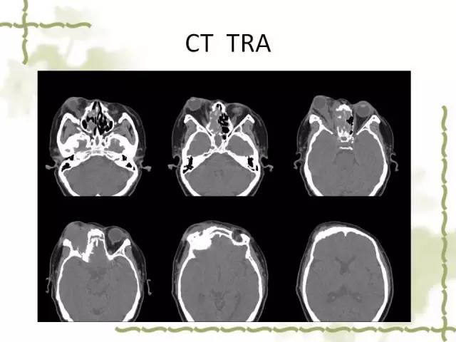 【病例】泪腺多形性腺癌1例MR影像表现