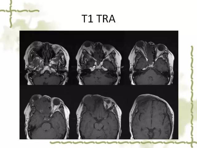 【病例】泪腺多形性腺癌1例MR影像表现