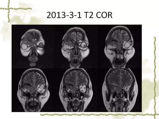 【病例】泪腺多形性腺癌1例MR影像表现