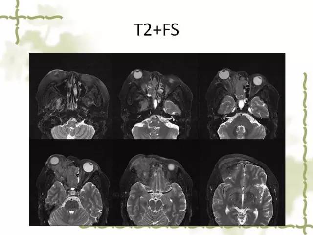 【病例】泪腺多形性腺癌1例MR影像表现