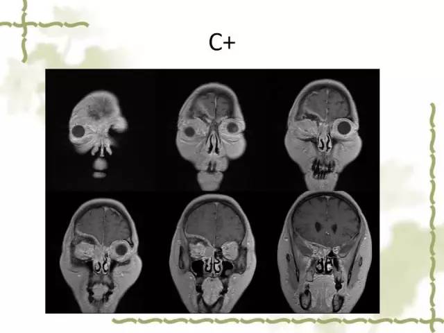 【病例】泪腺多形性腺癌1例MR影像表现