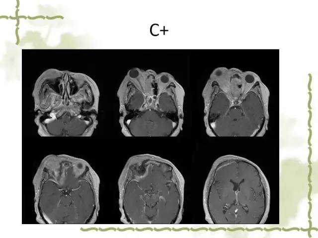 【病例】泪腺多形性腺癌1例MR影像表现