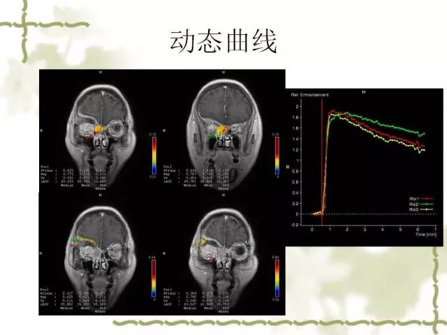 【病例】泪腺多形性腺癌1例MR影像表现