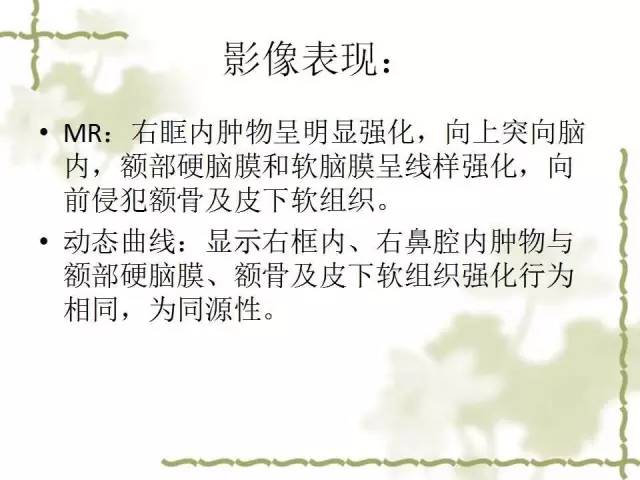 【病例】泪腺多形性腺癌1例MR影像表现