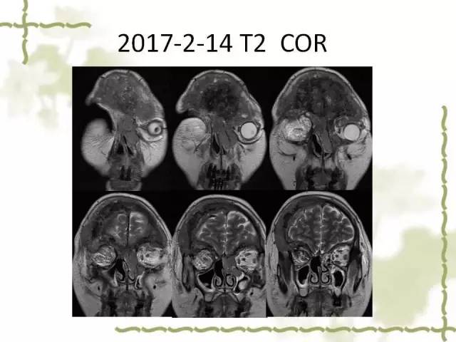 【病例】泪腺多形性腺癌1例MR影像表现
