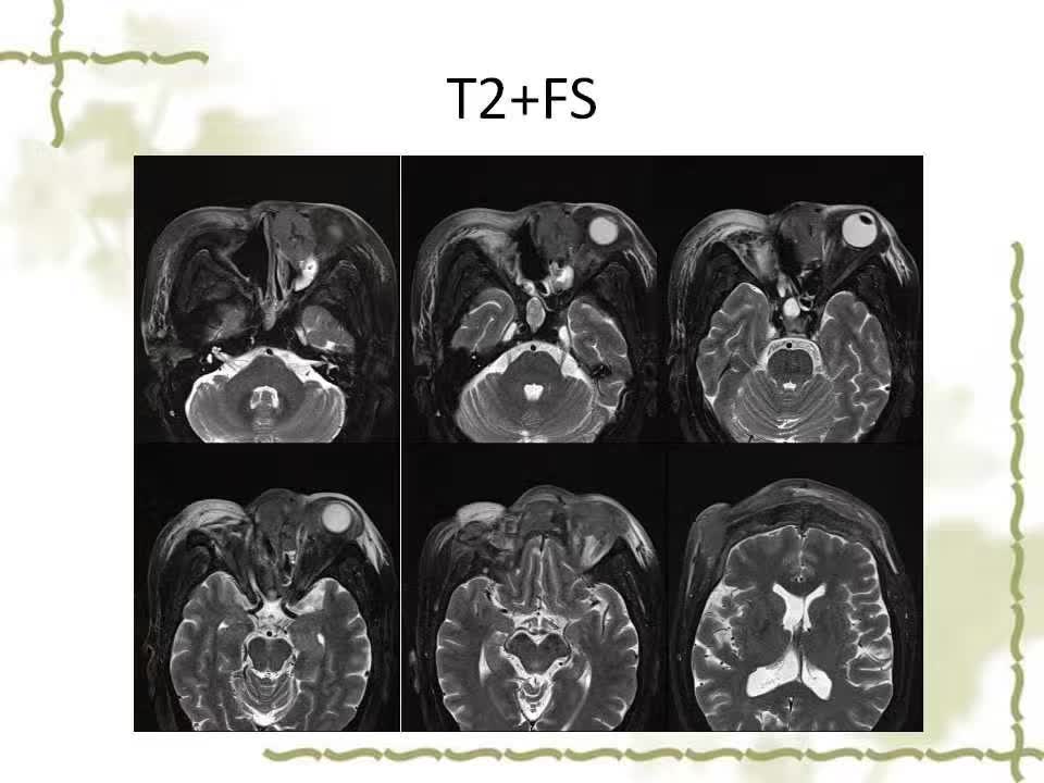 【病例】泪腺多形性腺癌1例MR影像表现