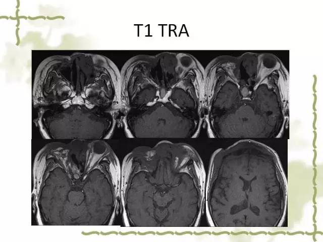 【病例】泪腺多形性腺癌1例MR影像表现