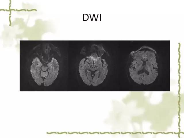 【病例】泪腺多形性腺癌1例MR影像表现