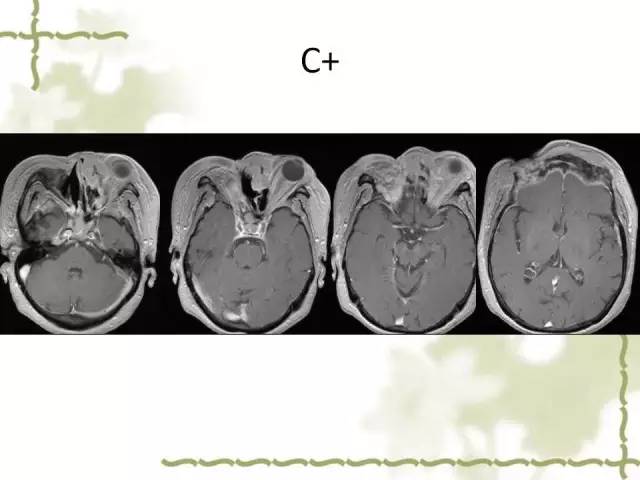 【病例】泪腺多形性腺癌1例MR影像表现