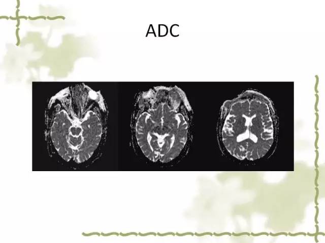 【病例】泪腺多形性腺癌1例MR影像表现