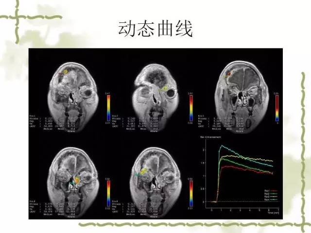 【病例】泪腺多形性腺癌1例MR影像表现