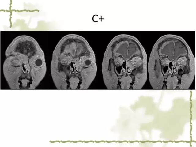 【病例】泪腺多形性腺癌1例MR影像表现