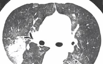 磨玻璃影?警惕9大感染性疾病 磨玻璃影?警惕9大感染性疾病