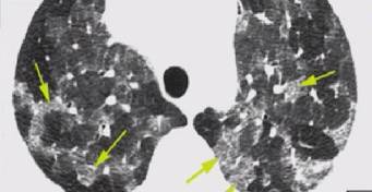 磨玻璃影?警惕9大感染性疾病 磨玻璃影?警惕9大感染性疾病