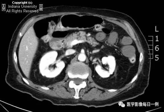 【病例】肠系膜上动脉急性血栓1例CT 【病例】肠系膜上动脉急性血栓1例CT