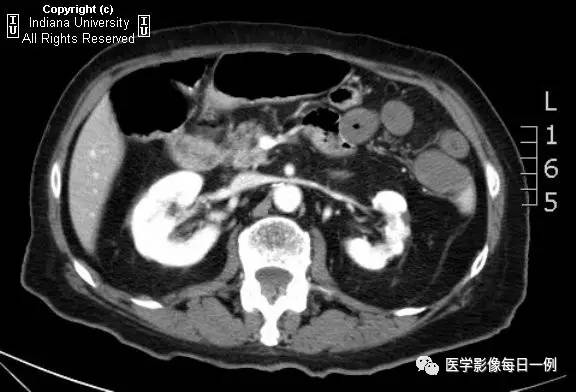 【病例】肠系膜上动脉急性血栓1例CT 【病例】肠系膜上动脉急性血栓1例CT