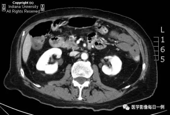 【病例】肠系膜上动脉急性血栓1例CT 【病例】肠系膜上动脉急性血栓1例CT