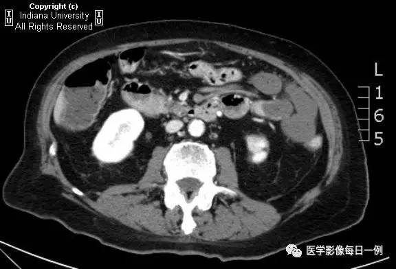 【病例】肠系膜上动脉急性血栓1例CT