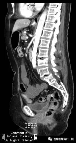 【病例】肠系膜上动脉急性血栓1例CT 【病例】肠系膜上动脉急性血栓1例CT