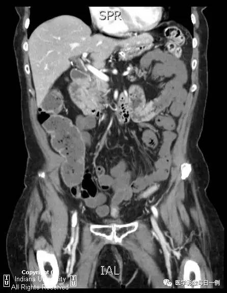 【病例】肠系膜上动脉急性血栓1例CT