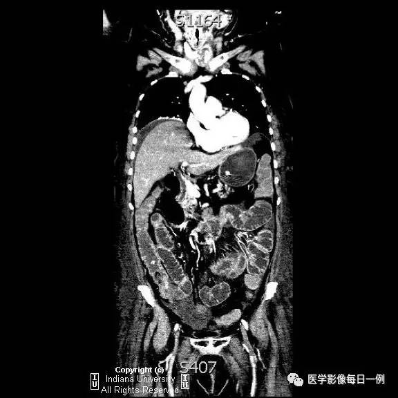 【病例】肠系膜上动脉急性血栓1例CT 【病例】肠系膜上动脉急性血栓1例CT