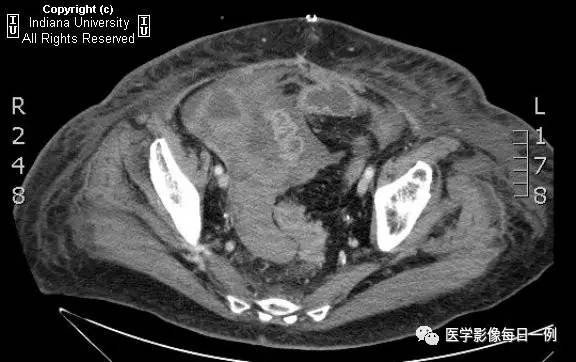【病例】肠系膜上动脉急性血栓1例CT 【病例】肠系膜上动脉急性血栓1例CT