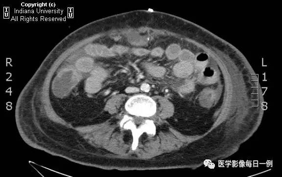 【病例】肠系膜上动脉急性血栓1例CT 【病例】肠系膜上动脉急性血栓1例CT