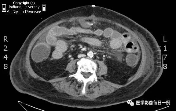 【病例】肠系膜上动脉急性血栓1例CT 【病例】肠系膜上动脉急性血栓1例CT