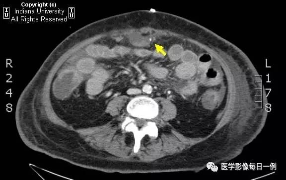 【病例】肠系膜上动脉急性血栓1例CT 【病例】肠系膜上动脉急性血栓1例CT