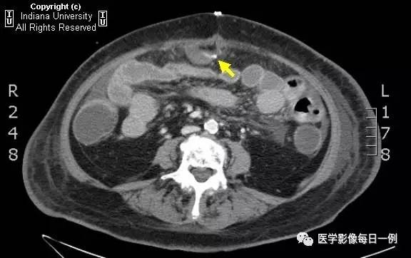 【病例】肠系膜上动脉急性血栓1例CT 【病例】肠系膜上动脉急性血栓1例CT