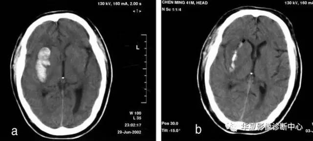 出血性腔隙综合症 出血性腔隙综合症