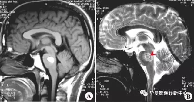 出血性腔隙综合症 出血性腔隙综合症
