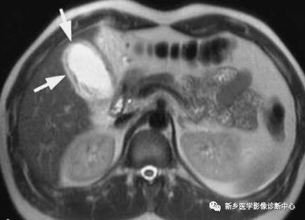 深度学习:13种胆囊炎性病变 深度学习:13种胆囊炎性病变