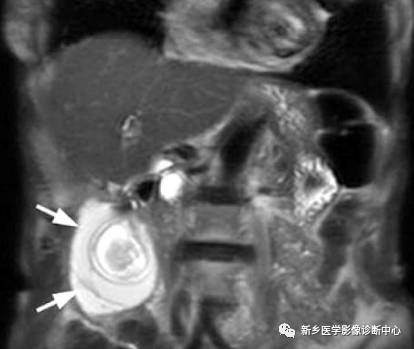 深度学习:13种胆囊炎性病变 深度学习:13种胆囊炎性病变