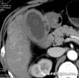 深度学习:13种胆囊炎性病变 深度学习:13种胆囊炎性病变