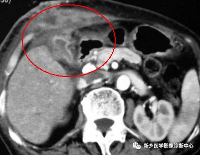 深度学习:13种胆囊炎性病变 深度学习:13种胆囊炎性病变