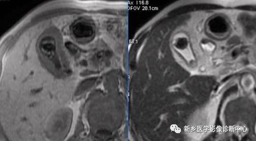 深度学习:13种胆囊炎性病变 深度学习:13种胆囊炎性病变