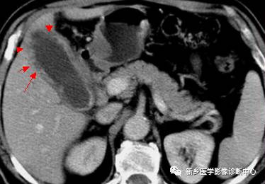 深度学习:13种胆囊炎性病变 深度学习:13种胆囊炎性病变