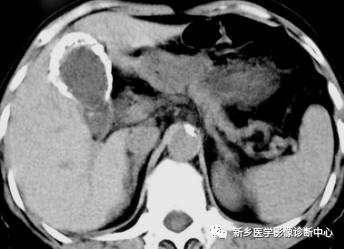 深度学习:13种胆囊炎性病变 深度学习:13种胆囊炎性病变