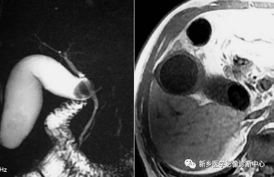 深度学习:13种胆囊炎性病变 深度学习:13种胆囊炎性病变