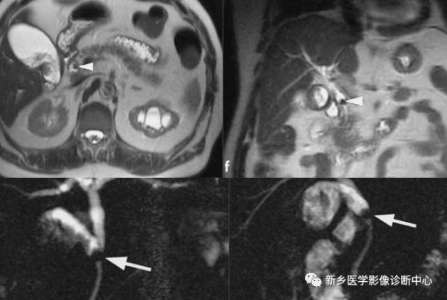 深度学习:13种胆囊炎性病变 深度学习:13种胆囊炎性病变