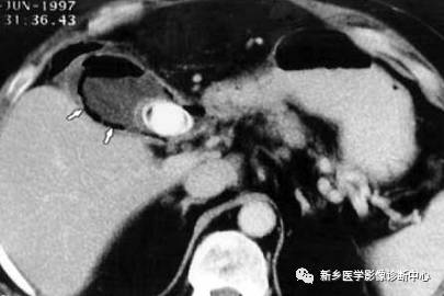 深度学习:13种胆囊炎性病变 深度学习:13种胆囊炎性病变