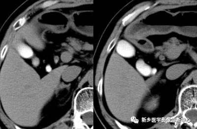 深度学习:13种胆囊炎性病变 深度学习:13种胆囊炎性病变