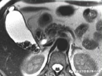 深度学习:13种胆囊炎性病变 深度学习:13种胆囊炎性病变